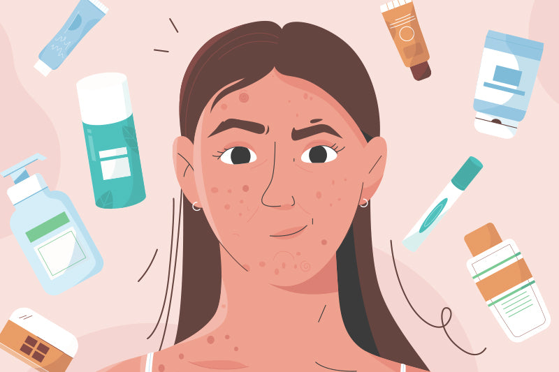 How to Create a Personalized Skincare Routine for Acne
