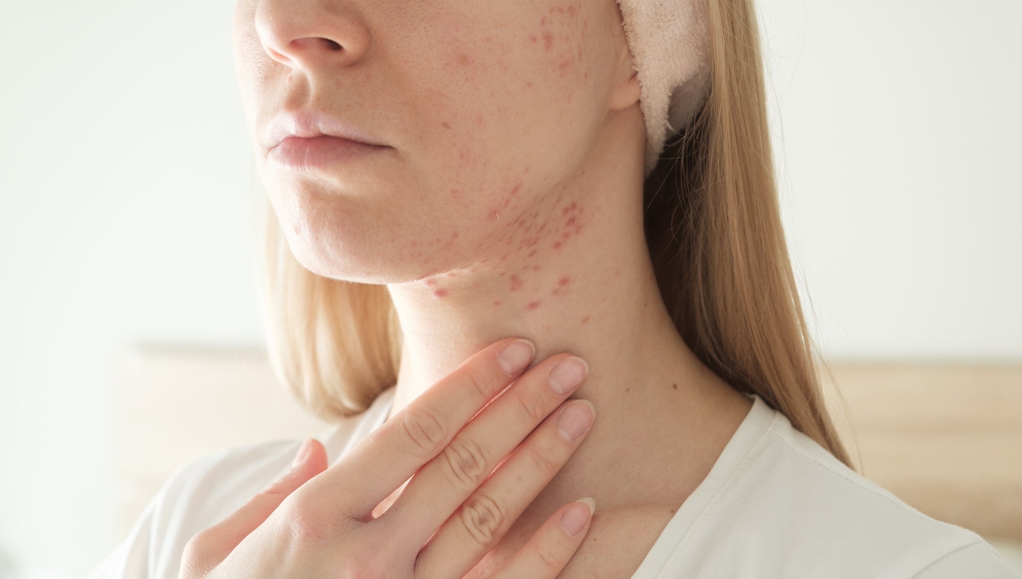 Do acne patches work on cystic acne?