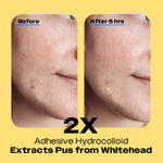 Comparison of skin appearance before and six hours after treatment with an Avarelle ZitOut Original 40 patch, highlighting a noticeable change in the affected area.