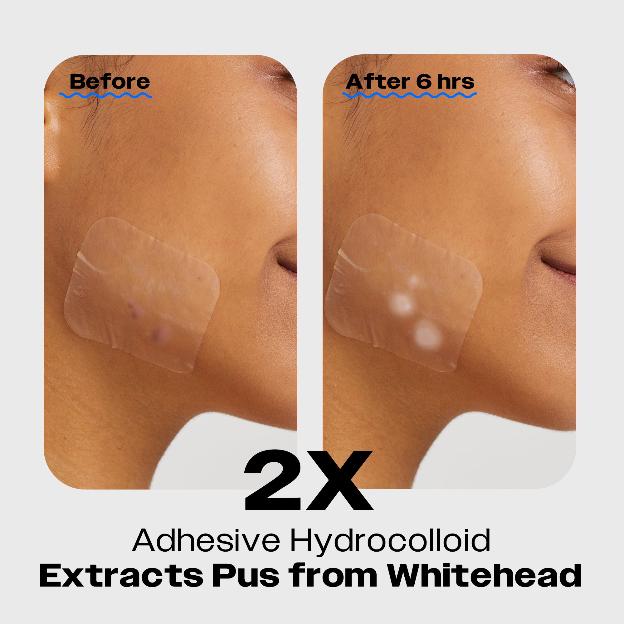Before and after comparison of skin with a whitehead, showing the effectiveness of an Avarelle ZitOut X-Large Acne Patch over a 6-hour period. Where the after patch has white spots where the pimples used to be.