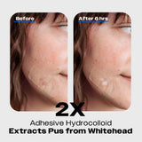 Comparison of skin before and after 6 hours of treatment with an acne patch containing Madecassic Acid, cica, tea tree oils and hydrocolloid that extracts pus from a whitehead, using Avarelle's ZITOUT FIT 16CT patch.