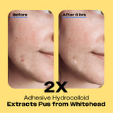 Before and after comparison of acne patches using Avarelle ZITOUT Invisible (AM) pimple patch with visible white pus resulting after 6 hours.  Emphasizing double hydrocolloid adhesive stick.