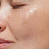 Close-up of a person's freckled cheek with two clear round transparent pimple patches on her face, showcasing Avarelle ZITOUT Invisible Acne Patch.