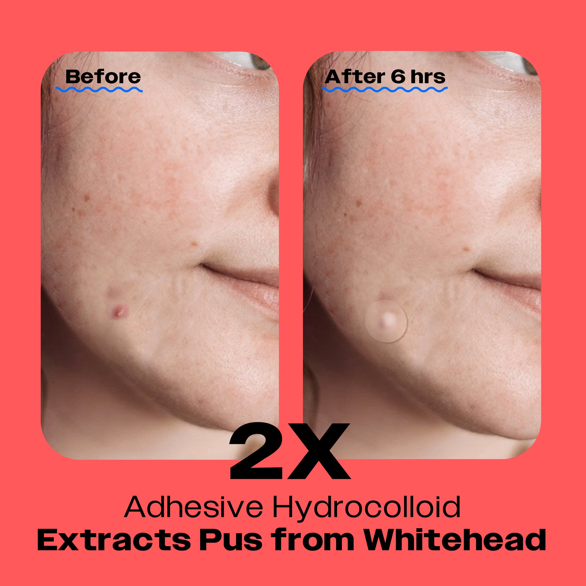 Comparison of skin before and after using Avarelle's ZitOut Original 80 acne patch with adhesive hydrocolloid for 6 hours to extract pus from a whitehead.