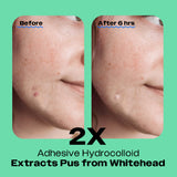 Comparison of acne treatment effectiveness: before and after 6 hours using an Avarelle ZITOUT Variety Traveler's Pack 40CT infused hydrocolloid and other skin friendly ingredients