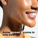 A woman with a smile, showcasing an Avarelle ZITOUT Variety Traveler's Pack 40CT on her cheek, exemplifying the variety of sizes of acne treatment.