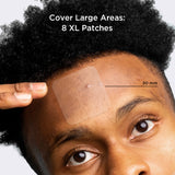 Back young man pointing at the x-large pimple patch on his forehead ontop of one big pimple.  With annotation saying 50mm pimple patches. With caption explaining cover large pimples with 8 xl patches